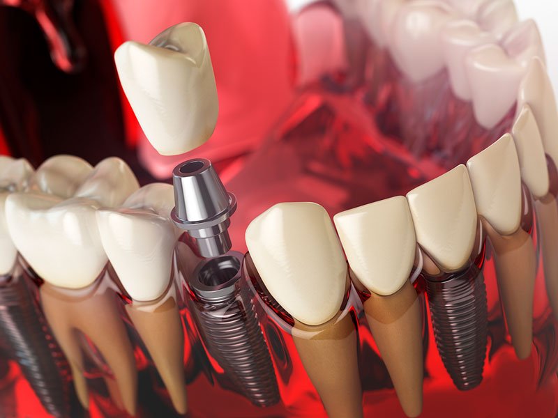 implante-dental-torremolinos